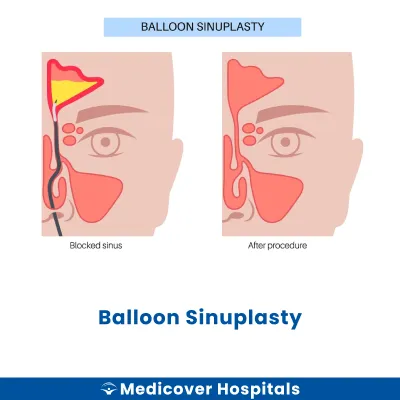 Balloon Sinuplasty