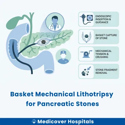 Basket Mechanical Lithotripsy for Pancreatic Stones