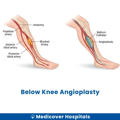 Below Knee Angioplasty