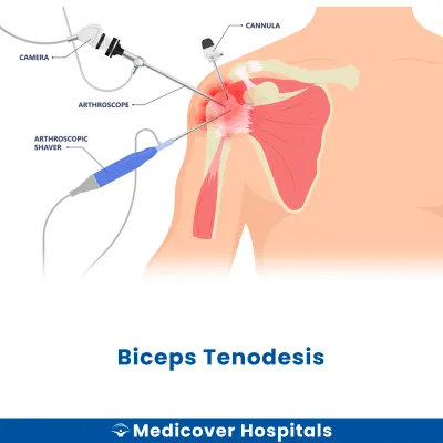 Biceps Tenodesis