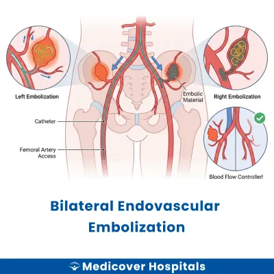 Bilateral Endovascular Embolization