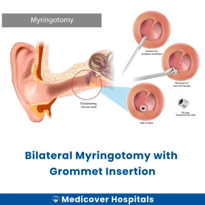 Bilateral Myringotomy With Grommet Insertion