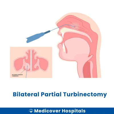 Bilateral Partial Turbinectomy