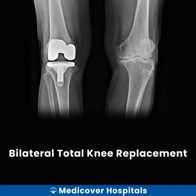 Bilateral Total Knee Replacement