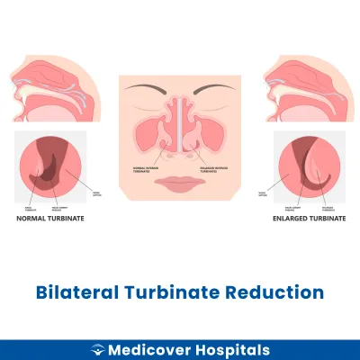 Bilateral Turbinate Reduction