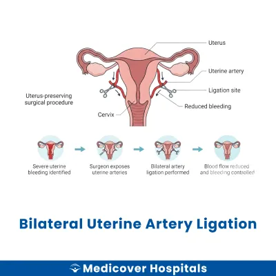 Bilateral Uterine Artery Ligation