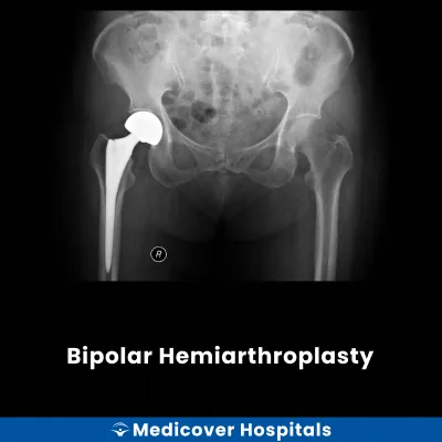 Bipolar Hemiarthroplasty