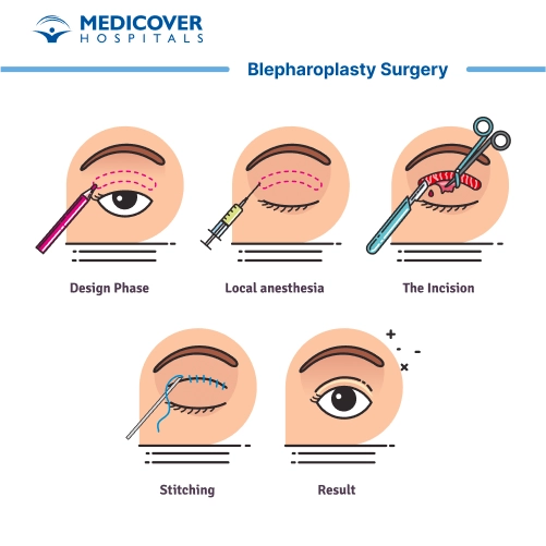 Blepharoplasty Surgery