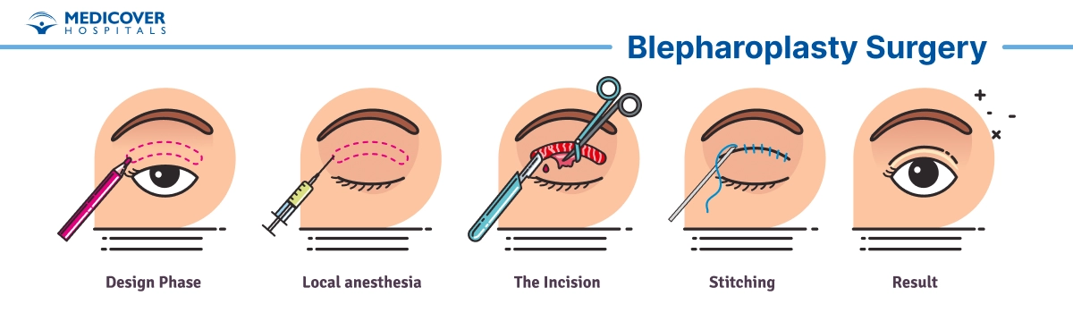 Blepharoplasty Surgery