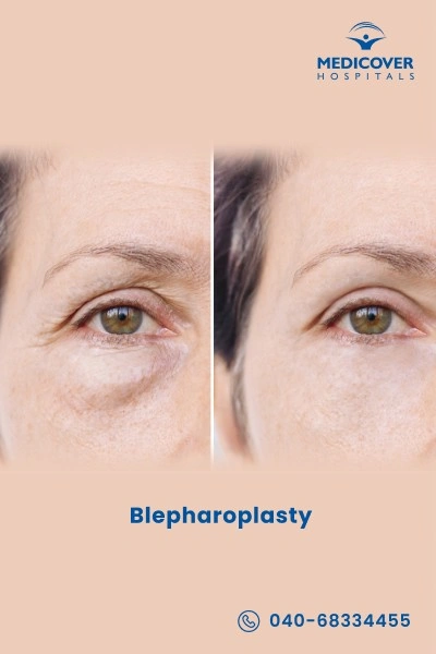 blepharoplasty
