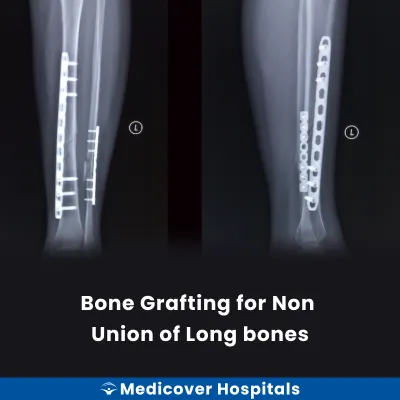 Bone Grafting for Non Union of Long Bones
