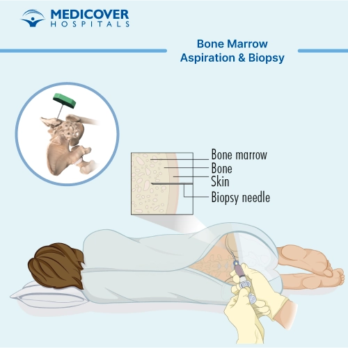 Bone Marrow Aspiration & Biopsy