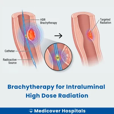 Brachytherapy for Intraluminal High Dose Radiation