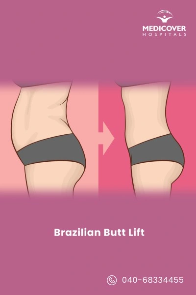 brazilian-butt-lift-surgery