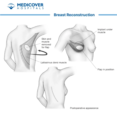 स्तन पुनर्निर्माण