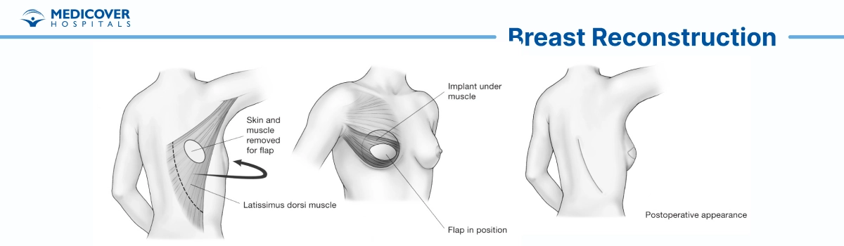स्तन पुनर्निर्माण