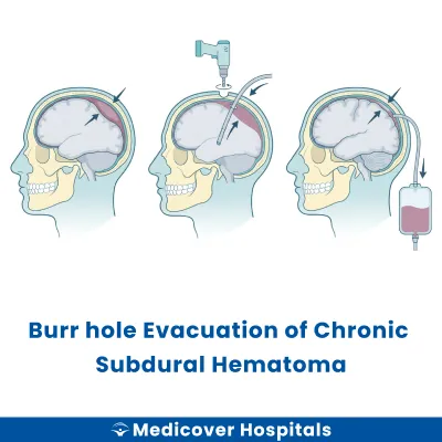 Burr Hole Evacuation of Chronic Subdural Hematoma