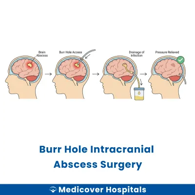 Burr Hole Intracranial Abscess Surgery