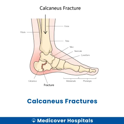 Calcaneus Fractures
