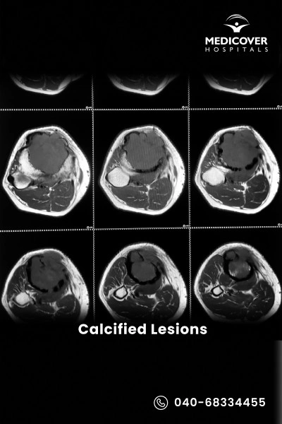 calcified-lesions