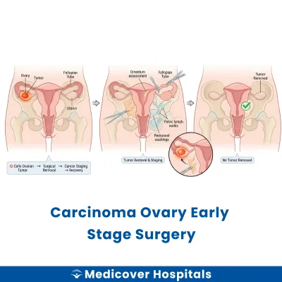 Carcinoma Ovary Early Stage Surgery