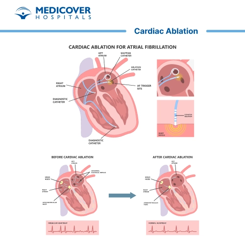 Cardiac ablation