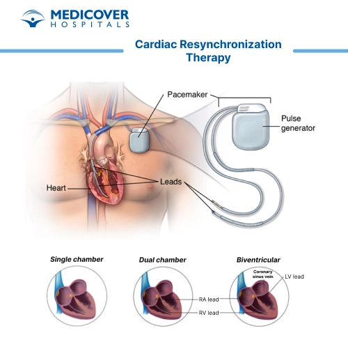 Cardiac resynchronization therapy