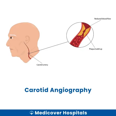 Carotid Angiography