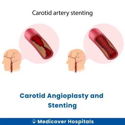 Carotid Angioplasty and Stenting