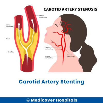 Carotid Artery Stenting