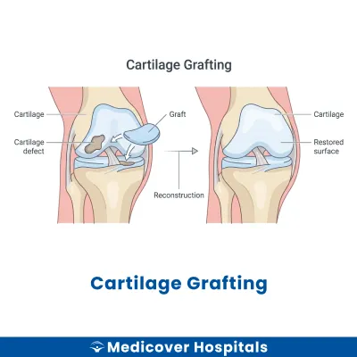 Cartilage Grafting