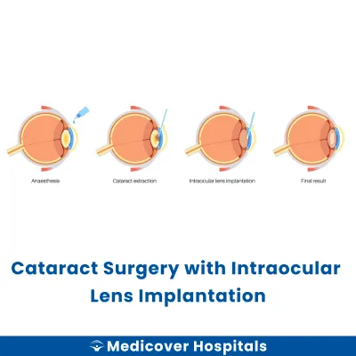 Cataract Surgery With Intraocular Lens Implantation