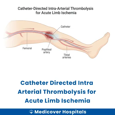 Catheter Directed Intra Arterial Thrombolysis for Acute Limb Ischemia