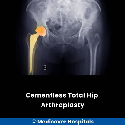 Cementless Total Hip Arthroplasty
