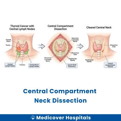Central Compartment Neck Dissection
