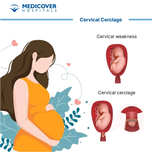 Cerclage cervical - Indications, procédure et récupération