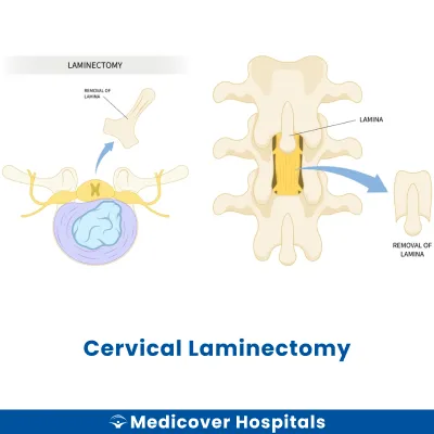 Cervical Laminectomy