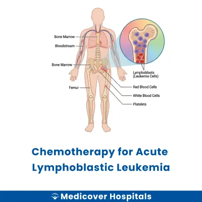 Chemotherapy for Acute Lymphoblastic Leukemia