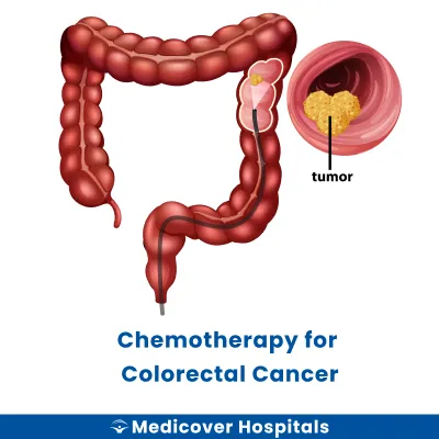 Chemotherapy for Colorectal Cancer