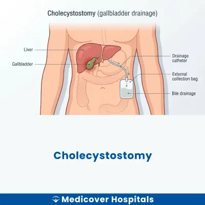 Cholecystostomy