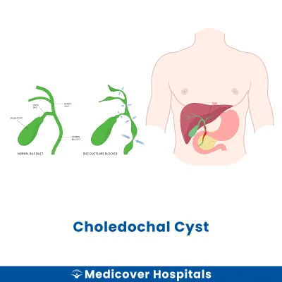 Choledochal Cyst