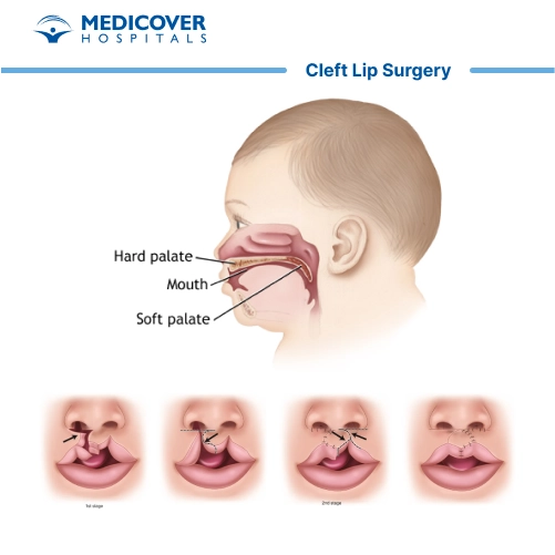 Cleft lip surgery