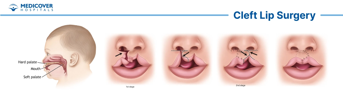 Chirurgie de la fente labiale