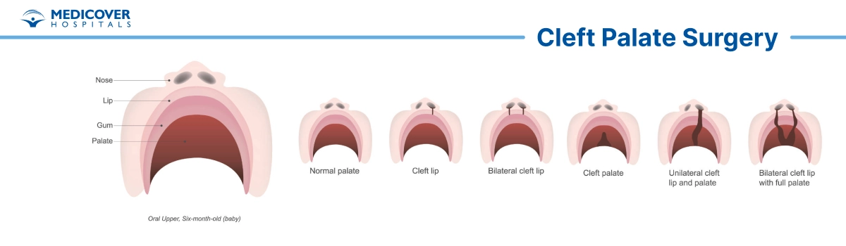 Cleft palate surgery