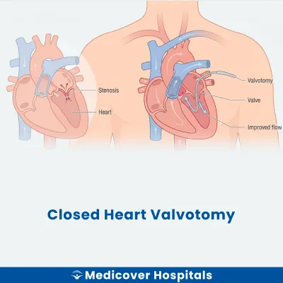 Closed Heart Valvotomy