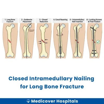 Closed Intramedullary Nailing for Long Bone Fracture