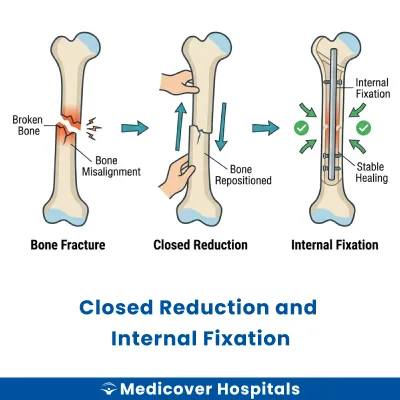Closed Reduction and Internal Fixation