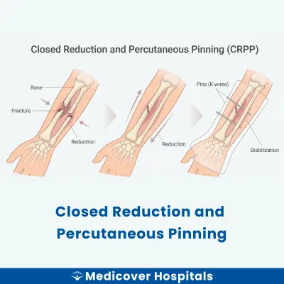 Closed Reduction and Percutaneous Pinning