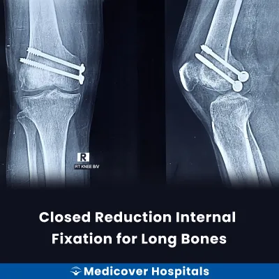Closed Reduction Internal Fixation for Long Bones