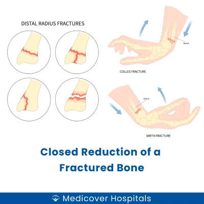 Closed Reduction of A Fractured Bone
